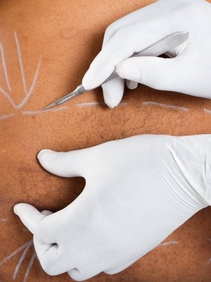 Restrictive or malabsorptive weight loss surgery